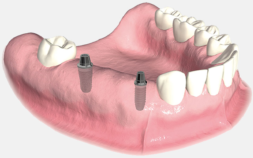The Cheapest Way to Replace a Missing Tooth